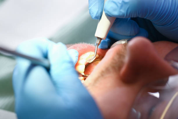 Best Emergency Dental Care for Broken or Chipped Teeth in Wright, WY